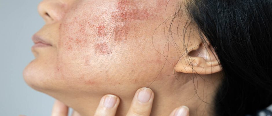 Understanding Skin Inflammation