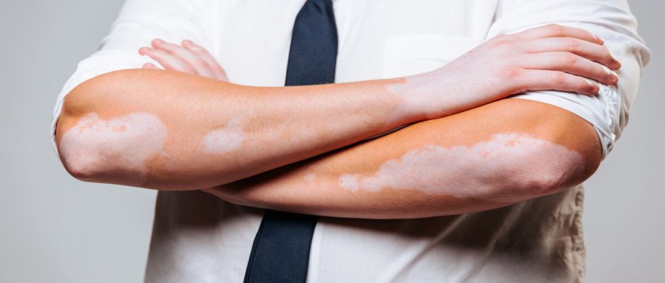 Recognizing Skin Conditions