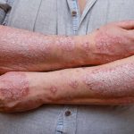 What Causes Acne: Understanding the Factors Involved?