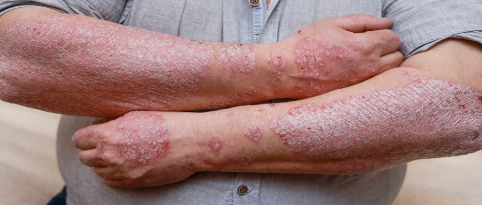 Managing Psoriasis Flare-Ups