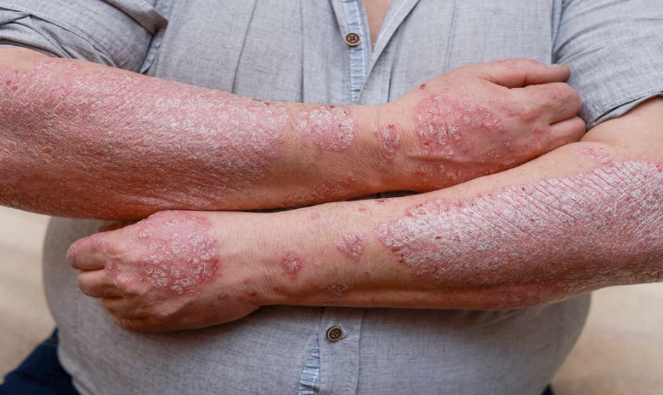 Managing Psoriasis Flare-Ups
