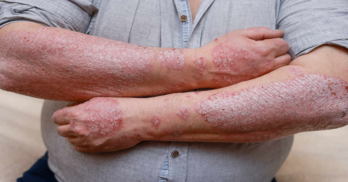 How Can You Manage Psoriasis Triggers Effectively?