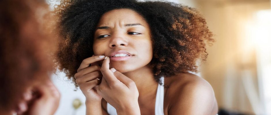 Acne Causes and Solutions