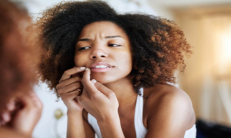 Acne Causes and Solutions